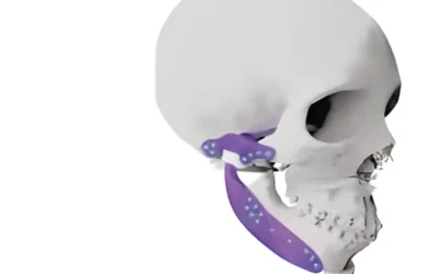 Implantes personalizados: cuándo se indican y qué ventajas ofrecen
