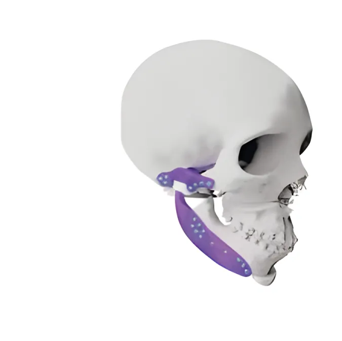 implantes personalizados